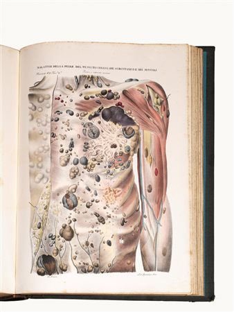 (Anatomia patologica Illustrati 800) CRUVEILHIER, Jean (1791-1874). Atlante...